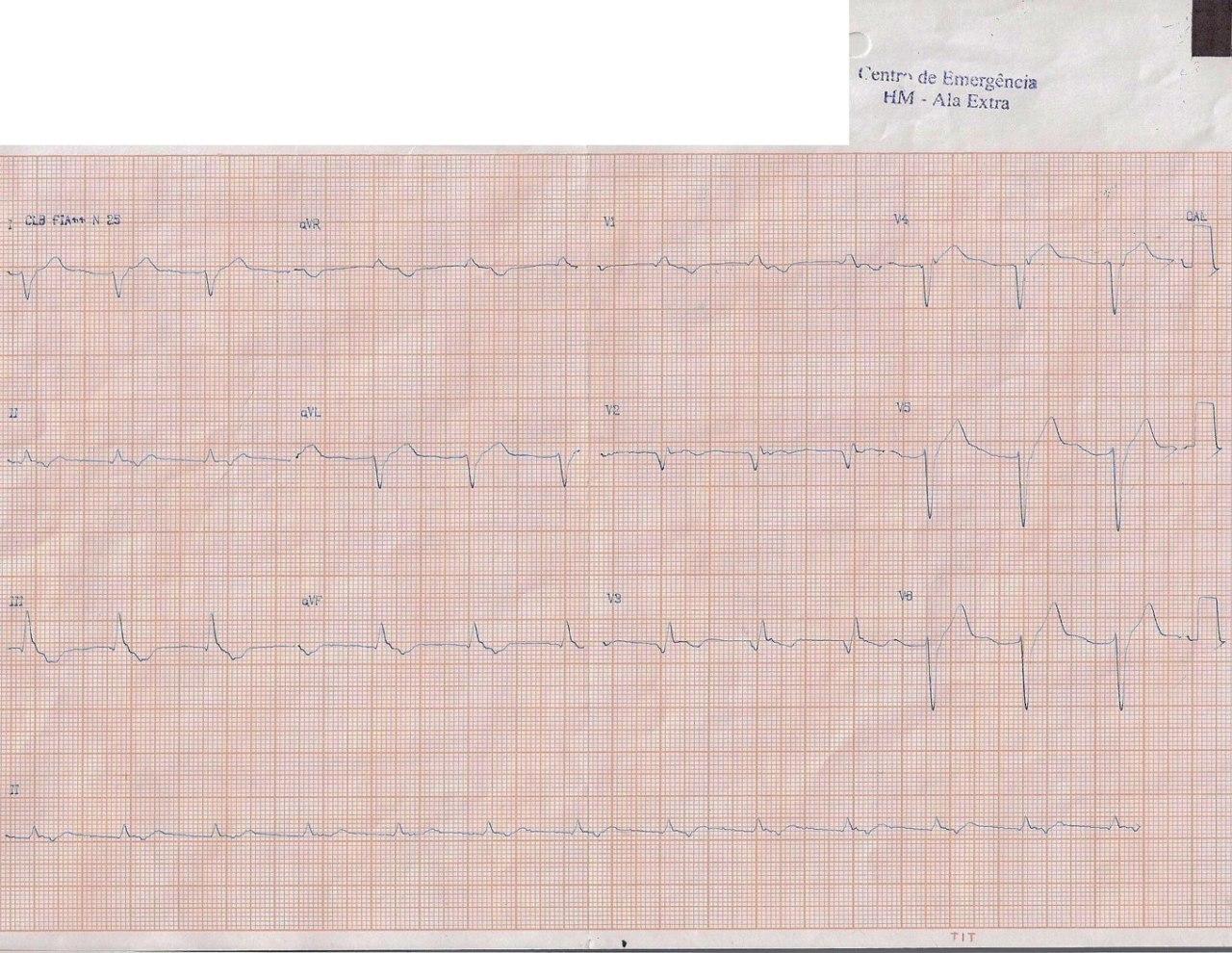 Hombre de 67 años que presenta episodio prolongado de ángor intenso que cede espontáneamente por suboclusión de la DA con RIVA y ondas T negativas como signos de reperfusión espontánea