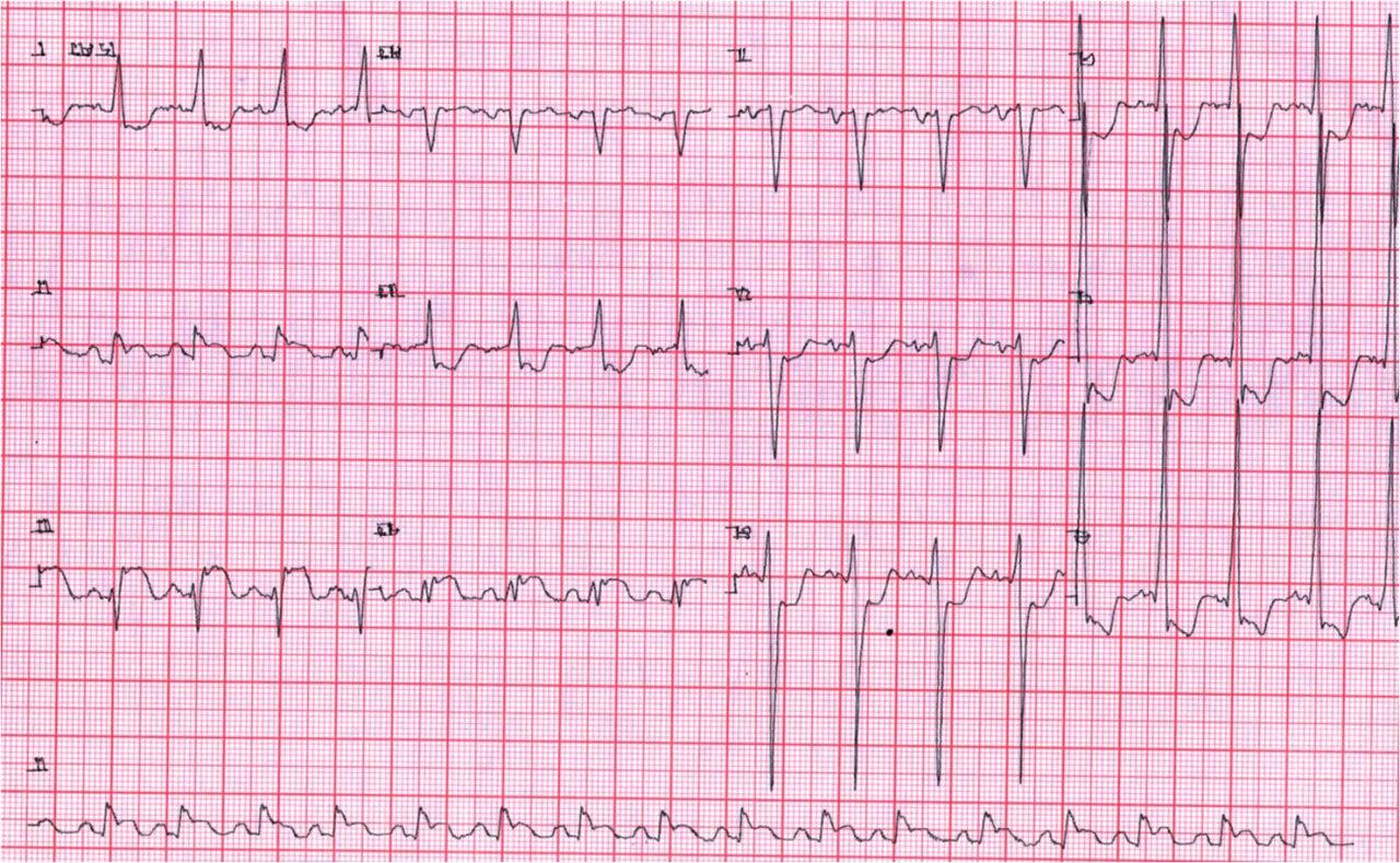 Paciente con episodio de ángor prolongado por SCA con desarrollo de IAM de cara inferior que presenta depresión del ST en derivaciones V4 – V6 por enfermedad concomitante de tres vasos