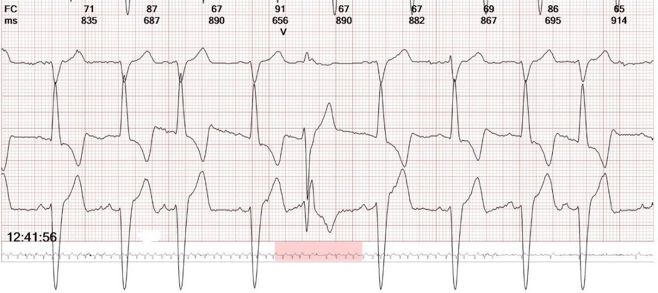 Mujer de 74 años con molestias toráccicas inespecíficas que presenta BRI en trazado basal y que a posteriori desarrolla un trastorno de conducción de similar aspecto que aparece en Fase 4