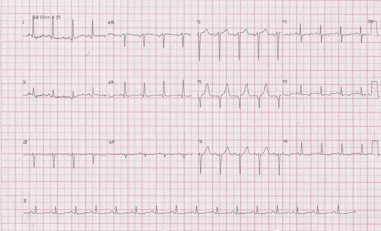 Mujer de 53 años, fumadora HTA y DBT, que presenta intenso dolor epigástrico a posteriori de la cena de Nochebuena, con ondas T altas en las derivaciones precordiales consideradas una variante normal en presencia de CCG normal con diagnóstico final comprobado de gastritis aguda severa