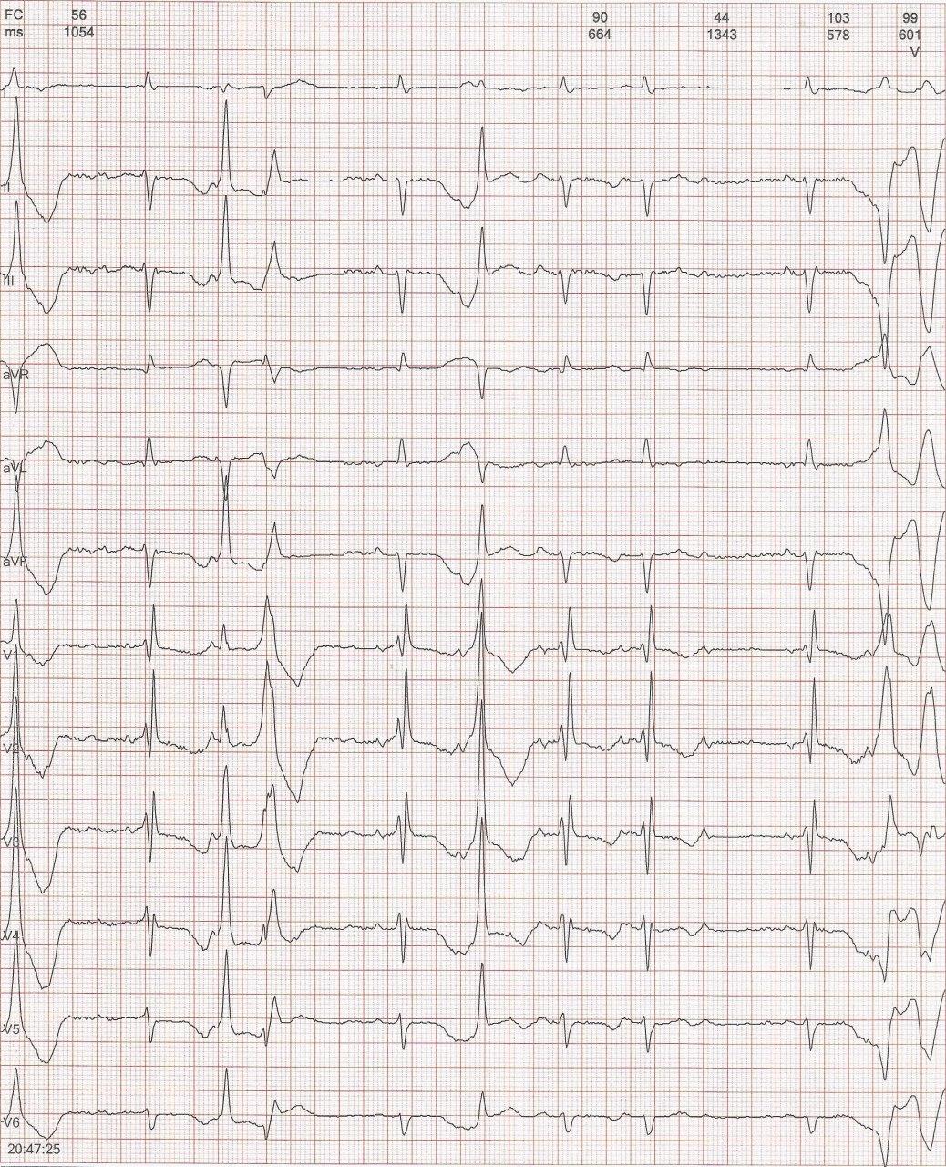 Mujer de 89 años, HTA en uso de diuréticos que presenta mareos y sensación de desmayo con extrasistolia auricular aberrada y extrasistolia ventricular frecuentes, un BAV 2:1, QT prolongado y desarrollo de TdP