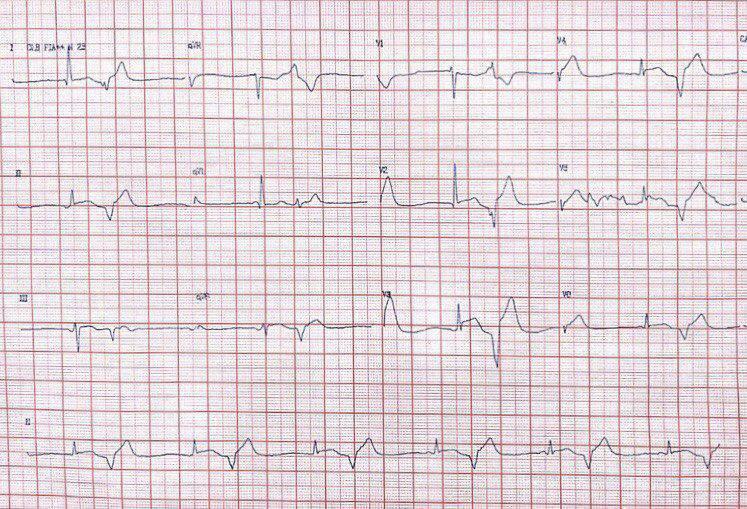 Mujer postmenopáusica con dolor precordial, disnea y palpitaciones relacionado con un evento emocional, que presenta extrasistolia ventricular frecuente por miocardiopatía de Takotsubo