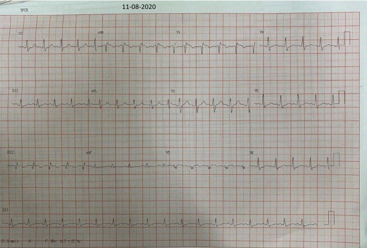 Mujer de 41 años que presenta cuadro de disnea súbita cuyo ECG muestra patrón S1Q3T3 por la presencia de tromboembolia pulmonar bilateral