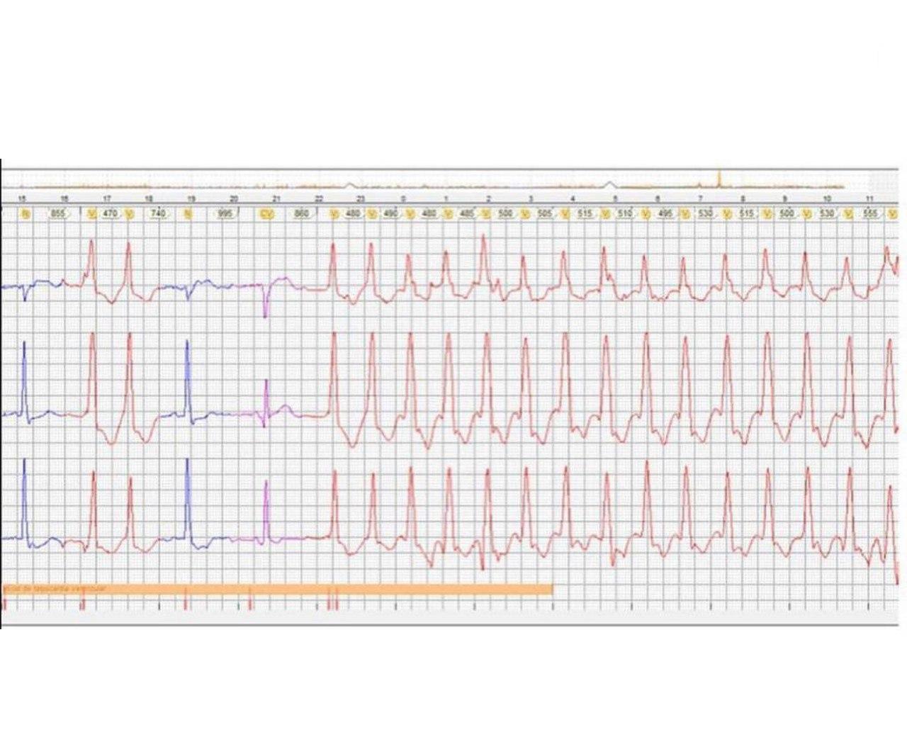 Hombre  portador de un CDI por prevención secundaria de MSC refiriendo múltiples descargas del dispositivo por activarse la terapia con ATP haciendo overdrive y terminando con la taquicardia