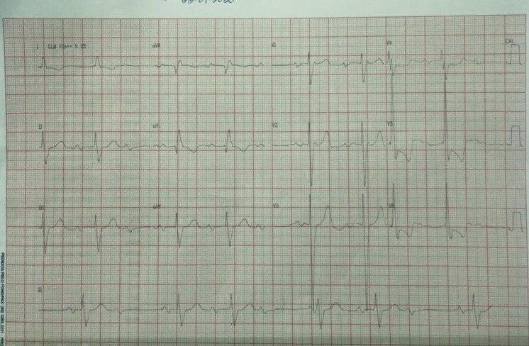 Paciente con insuficiencia cardíaca de origen isquémico que desarrolla un bloqueo AV de segundo grado, con prolongación previa del intervalo PR y ondas P bifásicas prefictoras de futura FA
