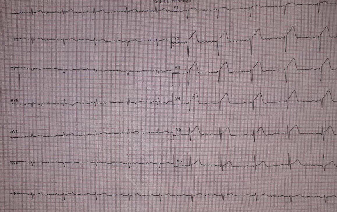 Hombre de 38 años que presenta episodio de ángor prolongado por presentar lesión transmural de cara anterior que se extiende a la región inferior por lesión de arteria descendente anterior (DA) muy extensa