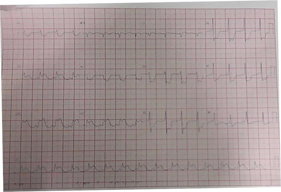 Hombre de 60 años que presenta ángor prolongado con baja saturación de O2 arterial por presentar compromiso CD total, suboclusión de TCI + DA, recibiendo revascularización de arteria culpable (CD) con colocación de stent farmacológico, con mejoría clínica y hemodinámica
