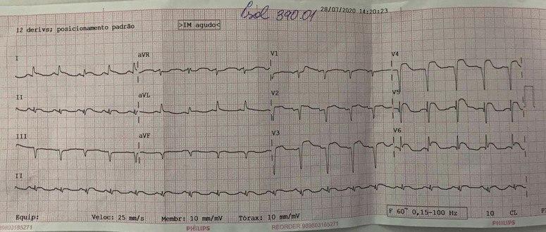 Mujer de 64 años que cursa cuadro de tipo gripal siendo medicada con azitromicina desarrollando derrame pleural y gran aumento de troponina y cuyo estudio angiográfico puso de manifiesto un síndrome de TakoTsubo