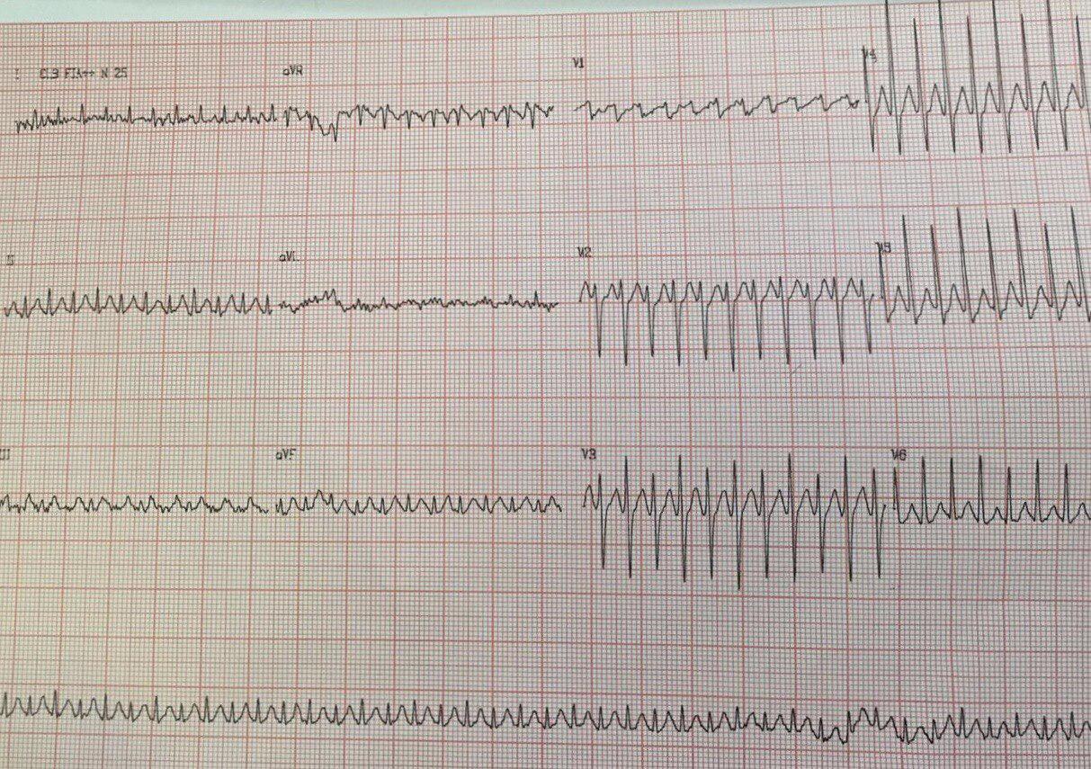Hombre de 53 años con palpitaciones debidas a aleteo auricular 1:1 que pasa a 2:1 con la inyección de adenosina que luego requiere CVE