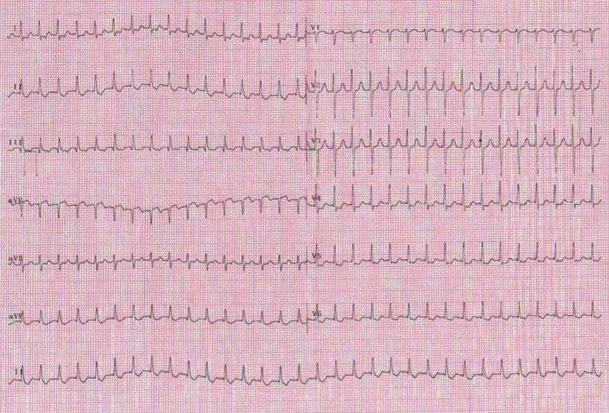 Mujer de 47 años con palpitaciones que presenta TSV ortodrómica mostrando en DI y AVL onda P retrógrada con con PR <PR e intervalo PR> 80 ms por vía accesoria lateral izquierda