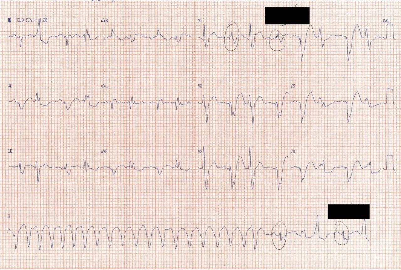 Paciente femenina de 61 años, portadora de  marcapasos que refiere ángor prolongado y que presenta criterio de Sgarbosa con desarrollo de TV