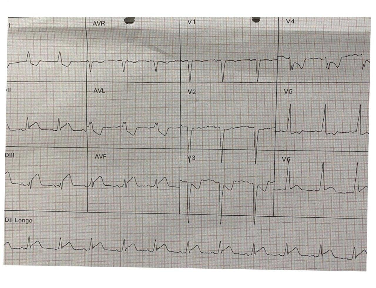 Mujer de 93 años que presenta dolor toráccico y vómitos con baja saturación arterial, que presenta SCA por compromiso de la arteria MgCx