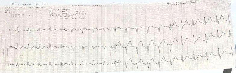 Paciente que presenta episodio de ángor recibiendo tenecteplase, cuyo ECG de control muestra Ondas T negativas y desaparición del supradesnivel ST como signo de reperfusión de la DA
