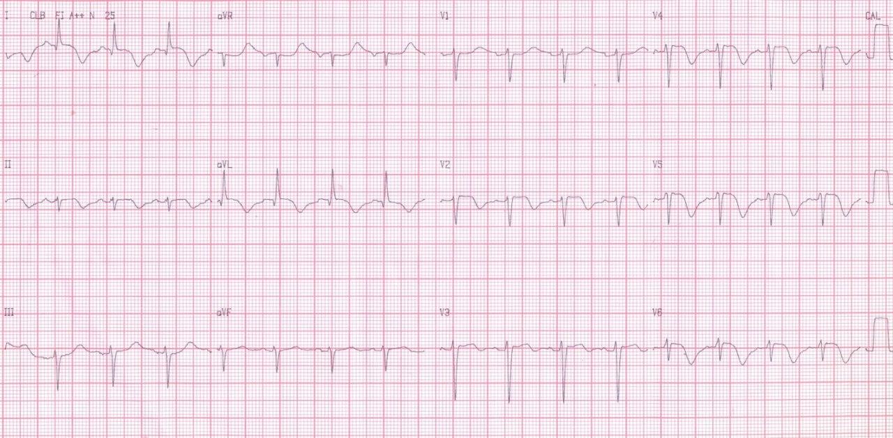 Paciente anciano  con dolor en el pecho asociado con sudoración y náuseas con presencia de CCG normal estableciéndose el diagnóstico de síndrome de Tako Tsubo