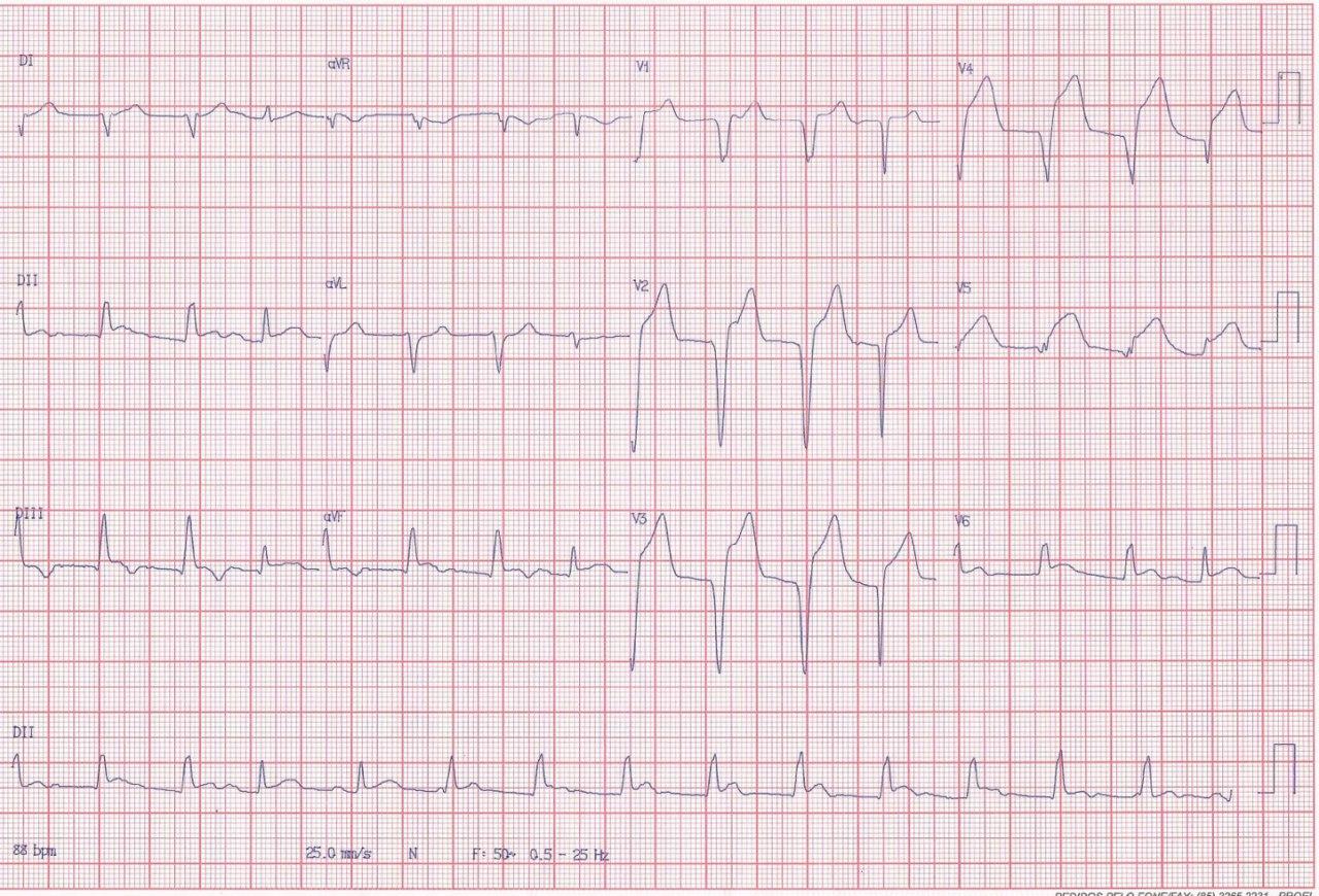 ECG de paciente con SCA que presenta ritmo idioventricular intermitente por compromiso de CD y DA con sendas obstrucciones totales