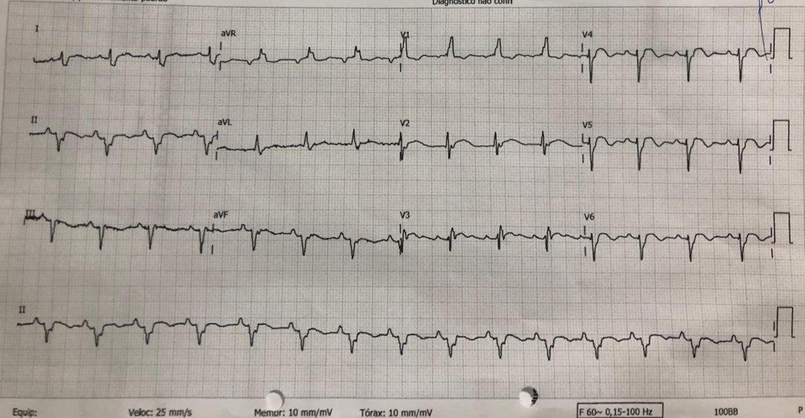Mujer de 74 años con factores de riesgo e implante de stent a la DA que presenta episodio de ángor típico en quién se constata lesión moderada del stent y presencia de balonamiento apical por síndrome de Tako Tsubo