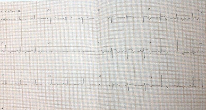Hombre de 56 años, asintomático con antecedente de diabetes tipo II cuyo ECG muestra ondas T negativas en cara anterior en espera de RNM para descartar miocardiopatía hipertrófica apical