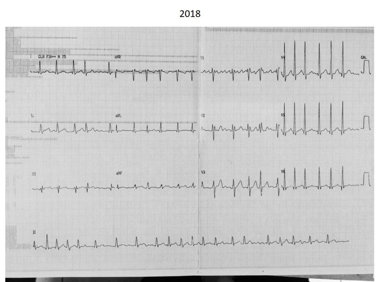 Paciente de 29 años que presenta en 2018 cuadro de ICC y FA que fué controlada farmacológicamente y que consulta nuevamente en 2020 para control