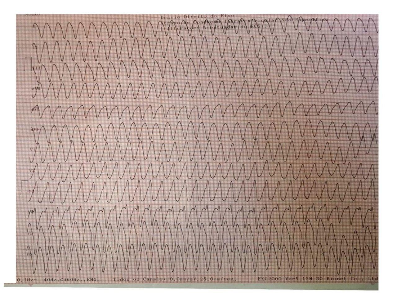 Hombre de 69 años con antecedente de IAM previo que ingresa por ángor, malestar general y sudoración que presenta TV