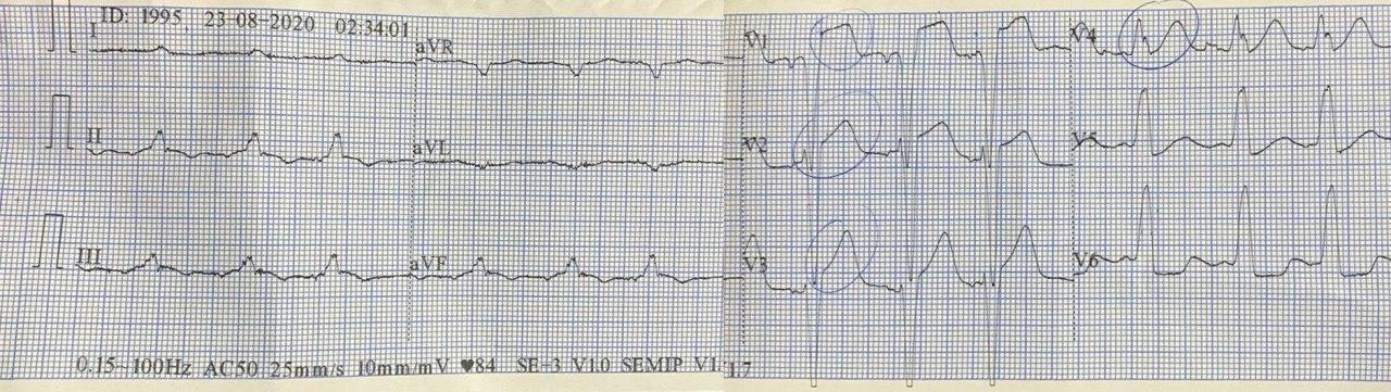 Hombre de 80 años con factores de riesgo e historia de enfermedad coronaria que comienza con ángor y vómitos llegando al Hospital con FV que logra revertirse aunque posteriormente la reitera con evolución al óbito