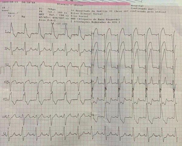 Hombre de 47 años portador de miocardiopatía dilatada que consulta por ángor y disnea cuyo ECG muestra en V4 onda T muy simétrica y picuda y QRS de baja amplitud secundarias a lesión oclusiva de 1º diagonal