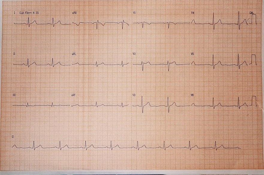 Hombre de 55 años con antecedentes familiares de MS y de FV recuperada que presenta varios episodios sincopales que presenta ECG y VCG típicos de síndrome de Brugada