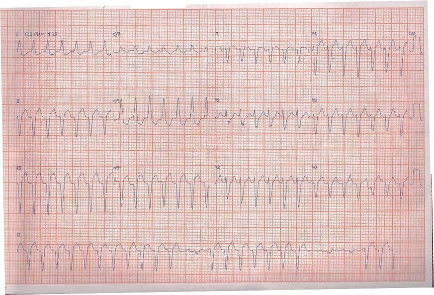Paciente masculino de 86 años con historia reciente de IAM que presenta una TV cuyo QRS es más angosto que el de ritmo sinusal por un origen ventricular cercano al tabique intraventricular y una activación más simultánea de los dos ventrículos