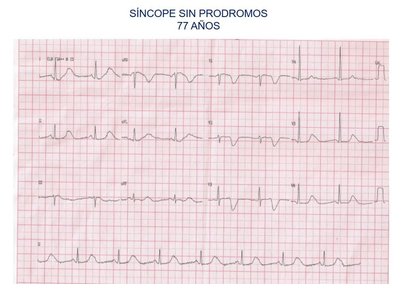 Mujer de 77 años que presenta «desmayo» sin pródromos cuyo ECG muestra probable bloqueo intra hisiano (QRS estrecho) con pseudopatrón de Wellens que se debe a la presencia de una onda P