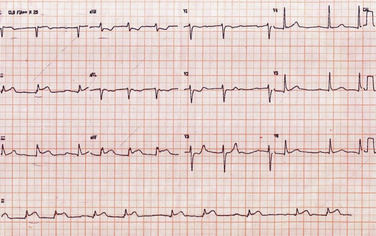 Masculino de 52 años con ángor prolongado cuyo primer ECG tiene un intercambio de electrodos de MMSS que evoluciona con una con tormenta eléctrica y bloqueo AV requiriendo MP transcutáneo con signos de repolarización precoz