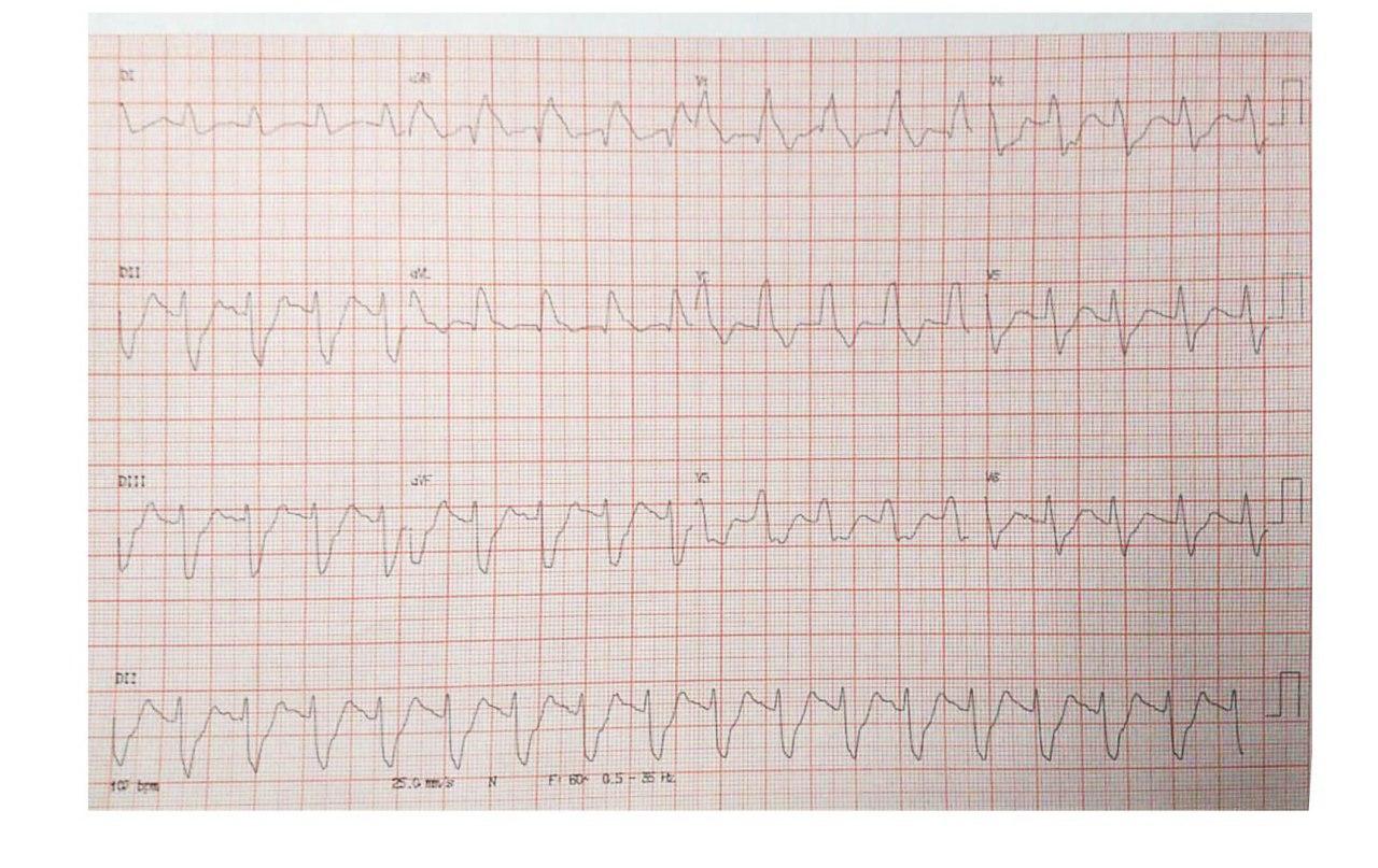 Paciente con dolor toráccico opresivo e inestabilidad hemodinámica que presenta taquicardia sinusal y sospecha de oclusión de TCI que fallece