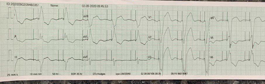Paciente de 83 años, portador de CA de próstata con MP bicameral implantado y antecedentes de ictus con troponinas elevadas ¿por SCA? que ingresa por sospecha de covid 19