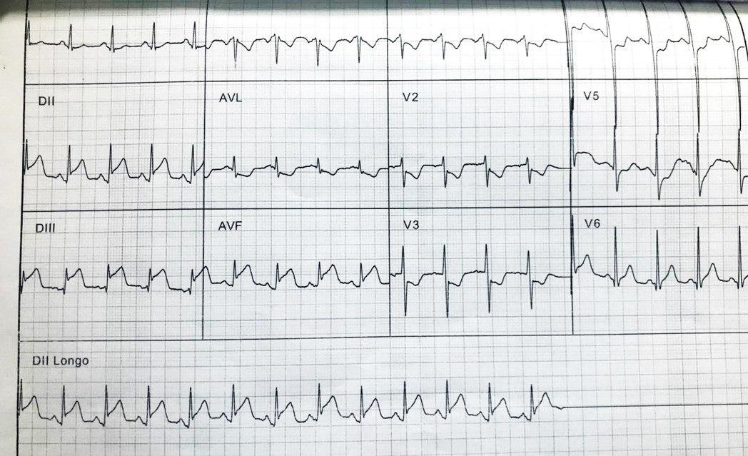 Paciente masculino hipertenso de 58 años que presenta episodio de ángor prolongado que recibe trombolíticos con signos de reperfusión que presenta una oclusión trombótica aguda por embolizaión distal de la coronaria Cx (sin placas)