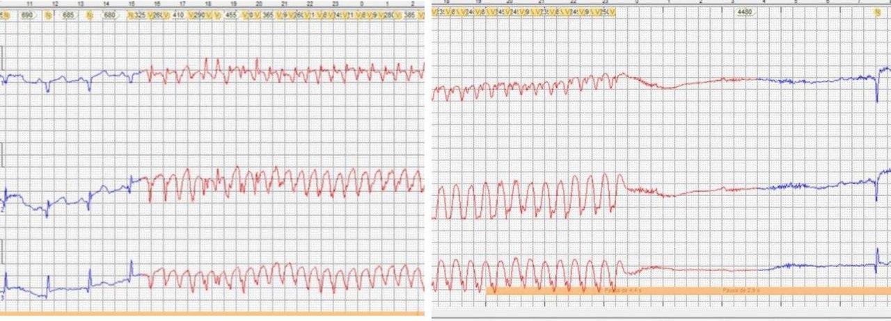 Mujer de 56 años que padece IAM ánterolateral hace doce días con colocación de stent en la DA provocando disfunción ventricular izquierda significativa y que comienza a presentar episodios sincopales por desarrollo de TV