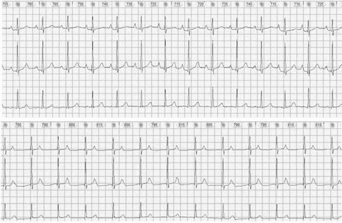 Mujer de 47 años que presenta TPSV no registrada en presencia de doble vía nodal