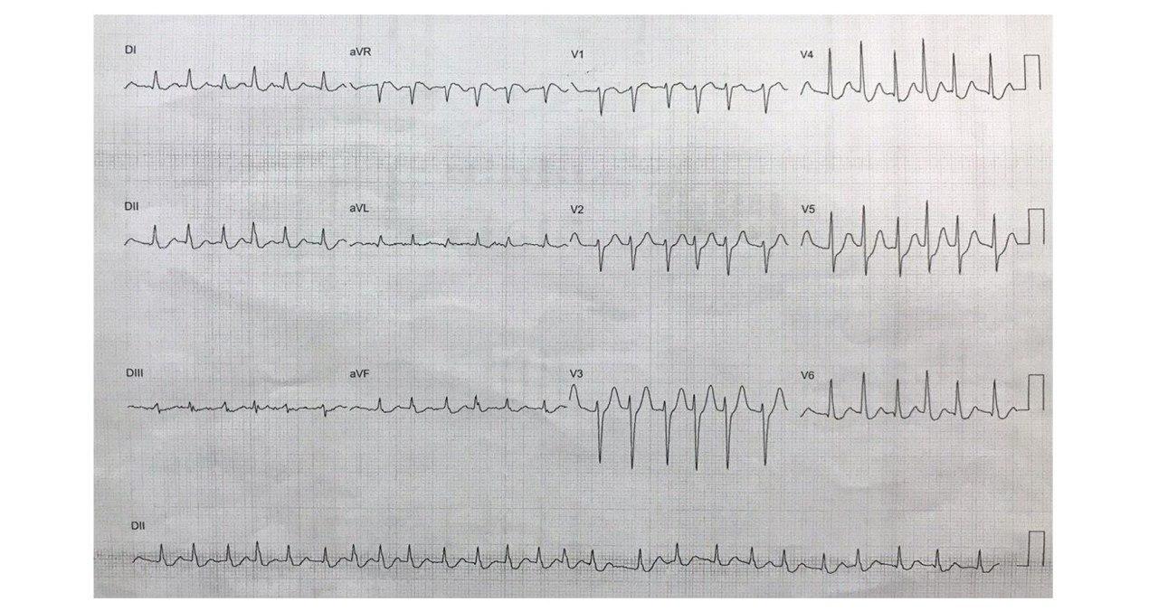 Mujer de 71 años con antecedentes de prolapso valvular que presenta episodio de dolor precordial y disnea ingresando con cuadro de EAP y presencia de soplo sistólico por ruptura de cuerdas tendinosas