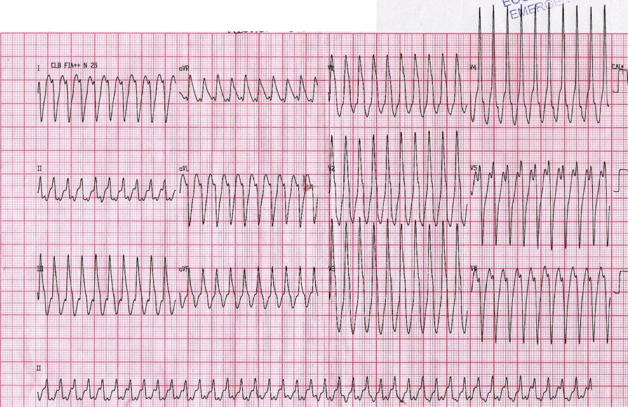 Paciente de 22 años con intensas palpitaciones recurrentes originadas en taquicardia ventricular fascicular anterior que requirió CVE en tres ocasiones