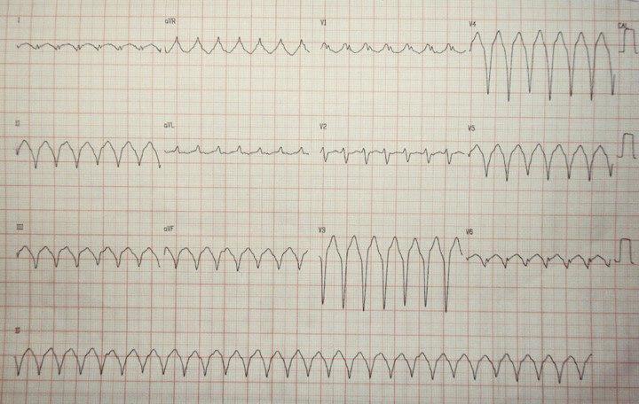 Paciente masculino de 52 años con palpitaciones y presíncope desde hace 24 horas que tiene antecedentes de miocardiopatía chagásica y presencia de aneurisma apical con implante de CDI hace tres años y tratamiento con amiodarona en quién se detecta una TV originada en la zona del aneurisma