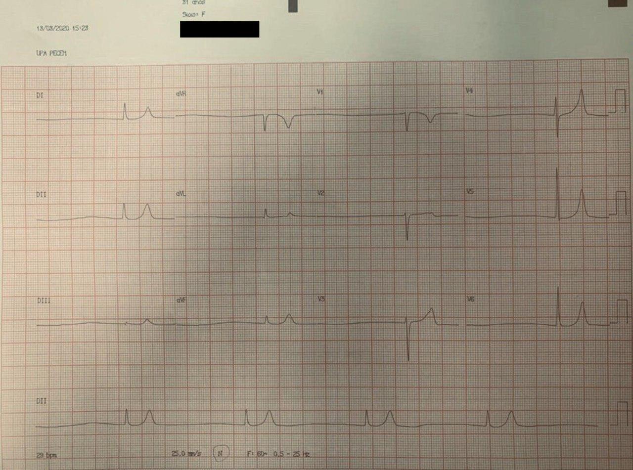 Hombre de 81 años en insuficiencia renal crónica dialítica que falta a una sesión de diálisis sufriendo vértigos y caída por presentar ritmo de la unión AV vinculado a severa hiperpotasemia