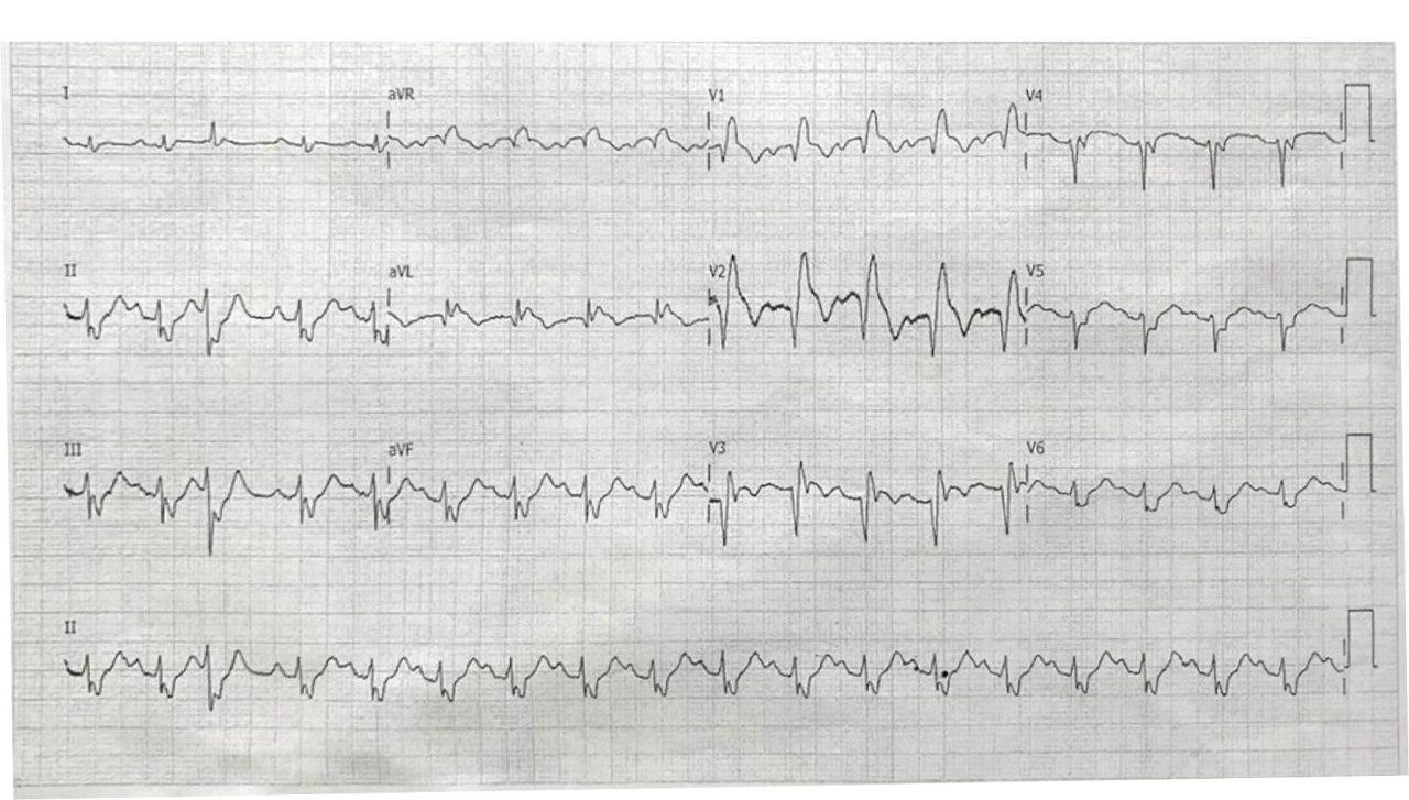 Hombre de 68 años con múltiples factores de riesgo que presenta ángor prolongado por IAM anterior extenso con desarrollo de BRD por oclusión de la DA antes de la 1º septal