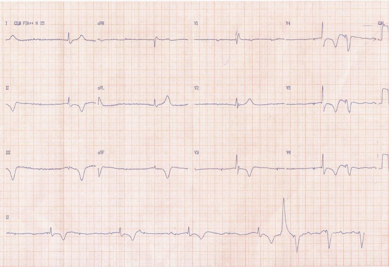 Paciente de 73 años con MP definitivo que evoluciona con mareos y síncope por fallo de captura debido al desplazamiento del electrodo