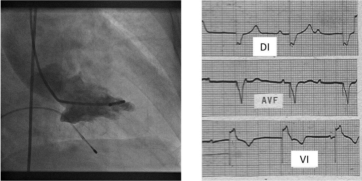 Paciente portador de BAVC sintomático al que se implanta MP transitorio comenzando con hipo por estimulación diafragmática atribuible a perforación y posterior recolocación del electrodo