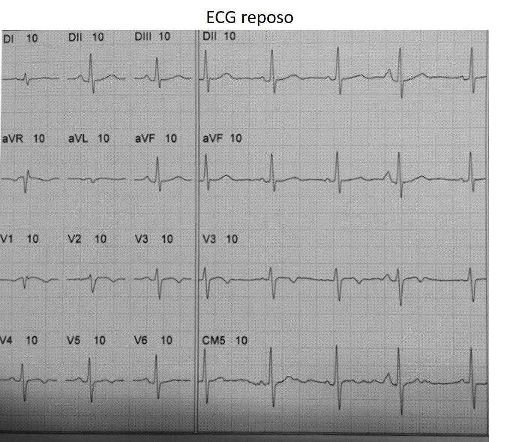Mujer de 66 años con antecedentes familiares de enfermedad coronaria que presenta episodios de ángor de esfuerzo desde una semana previa a quién se realiza PEG con desarrollo de supradesnivel  del ST en cara anterior + BRD + HBAI en quién se constata DA subocluída y Cx=70%