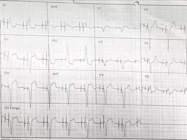 Paciente de 81 años, portador de marcapasos bicameral, que manifiesta ángor con probable afectación de VD que recibe tratamiento trombolítico en cuyo ECG se observa pérdida de captura auricular y que presenta una lesión suboclusiva residual en el ostium coronario derecho que se trató con éxito