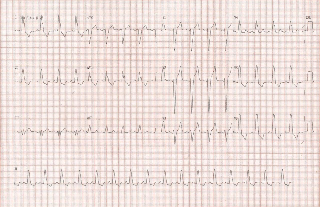 Paciente de 74 años portador de artritis reumatoidea y  enfermedad pulmonar intersticial que presenta disnea y ángor, con imagen ECG de BCRI y ondas T negativas secundarias a memoria cardíaca e isquemia miocárdica