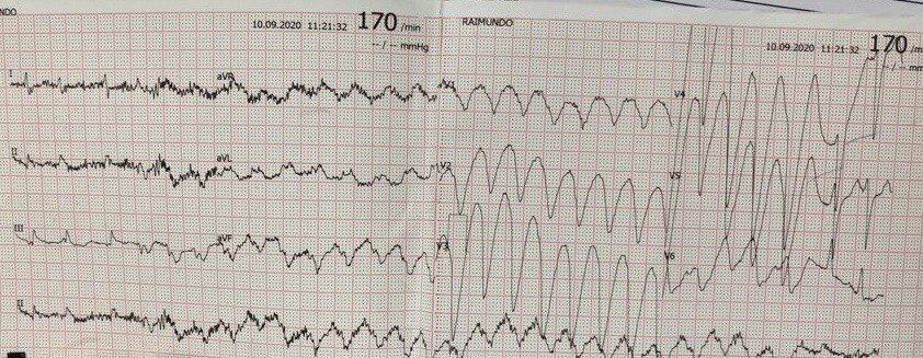 Mujer de 73 años con AA de base que es tratada con 600 mg oral propafenona sin BB, desarrollando un AA 1:1 con conducción aberrante simulando una TV