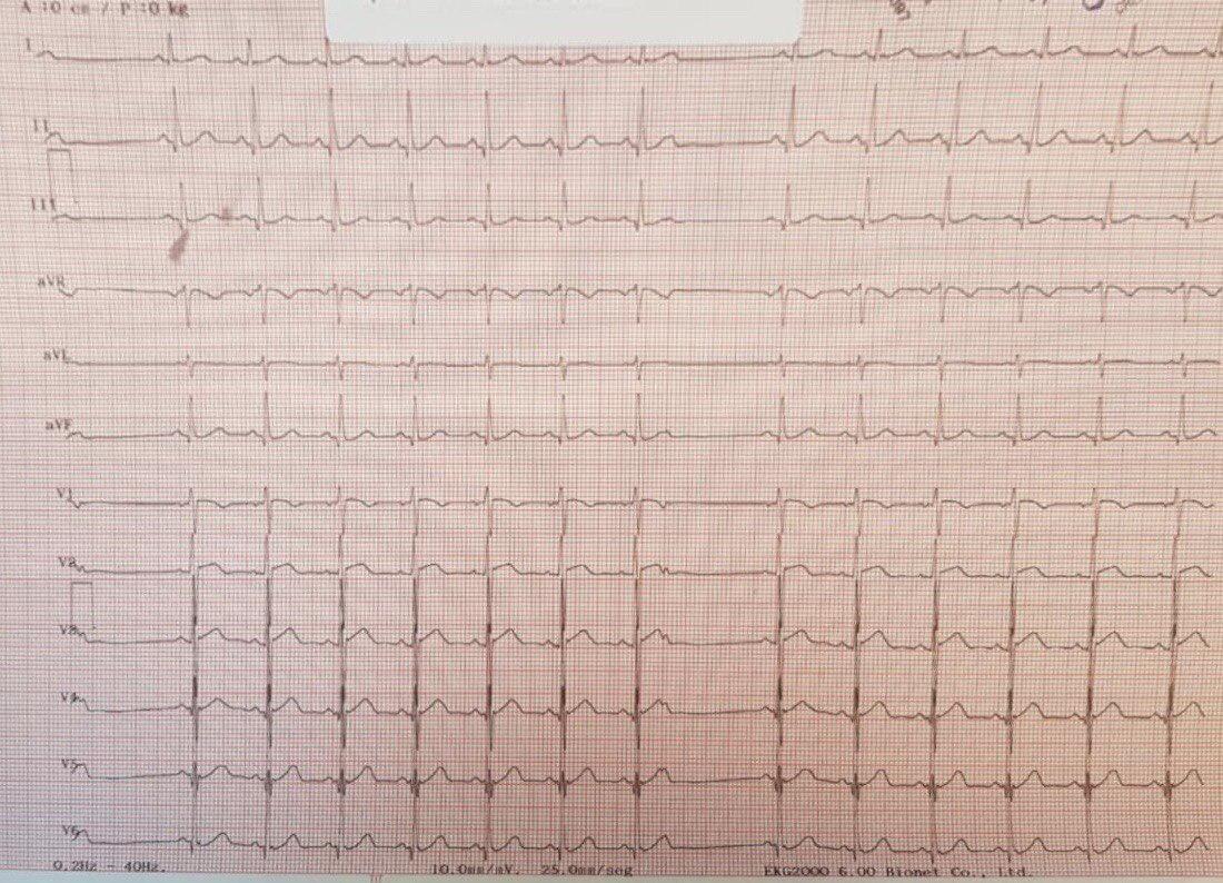 Paciente diabético tratado con metformina que desarrolla cuadro de pancreatitis biliar aguda, que cursa con hipokalemia cuyo ECG presenta extrasístoles auriculares bloqueadas  y a posteriori muestra un BCRI