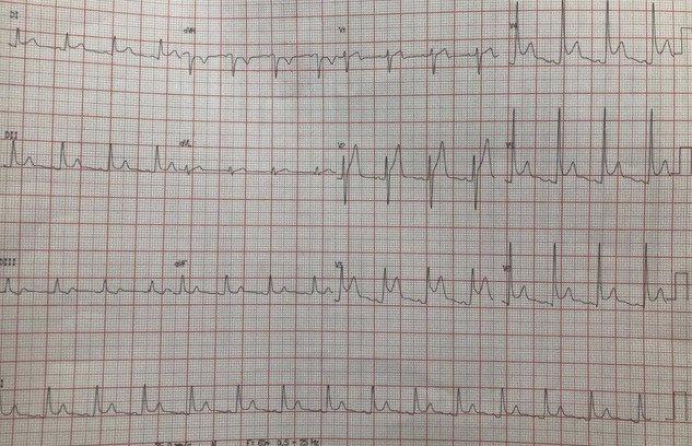 Varón de 19 años consumidor de cocaína que presenta precordialgia, con hostoria reciente de COVID 19 con troponina ultrasensible = 4.9 y  PRÓ-BNP = 2367 por desarrollo de miopericarditis