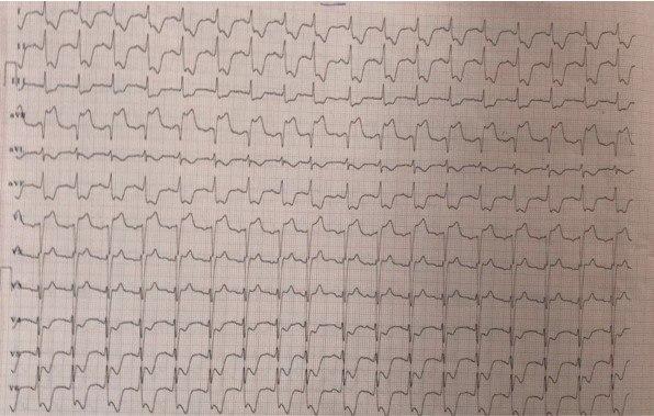 Paciente de 53 años portador de cardiopatía isquémica previa tratada, que presenta dolor precordial y epigástrico que llega a hemodinamia con EAP  a quién se efectúa angioplastia con implante de 2 stents para DA y 1 para CX con buena respuesta