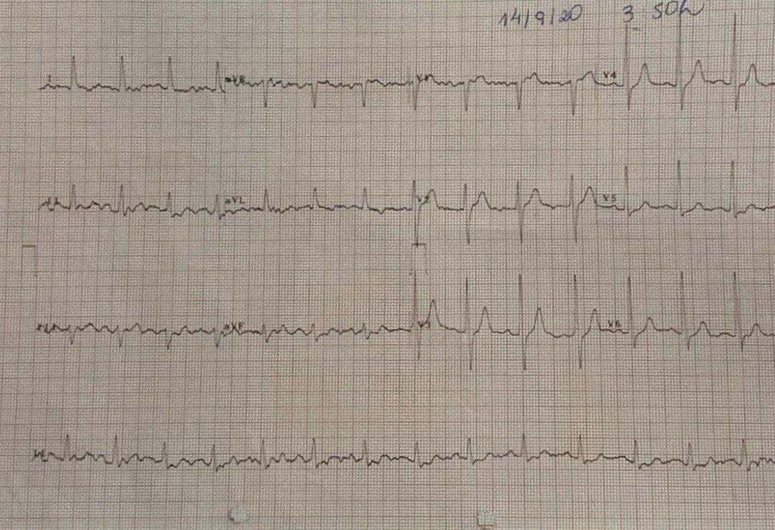 Hombre de 57 años, HTA y dislipémico que presenta ángor prolongado por oclusión de la DA con presencia de circulación colateral cuyo ECG evoluciona desde una isquemia grado I a un síndrome de Wellens