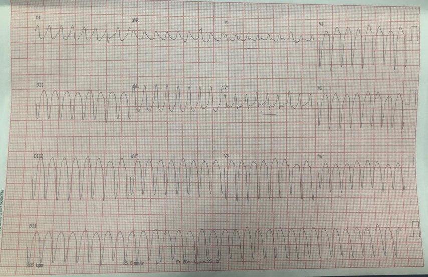 Paciente masculino de 77 años, HTA, DBT y tabaquista con disminución del nivel de consciencia que presenta TV que requiere CVE con la consecuente taquicardia sinusal y BAV1º con presencia de necrosis inferior por lesiones más graves en DA y CD